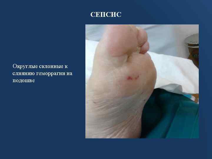 СЕПСИС Округлые склонные к слиянию геморрагии на подошве 