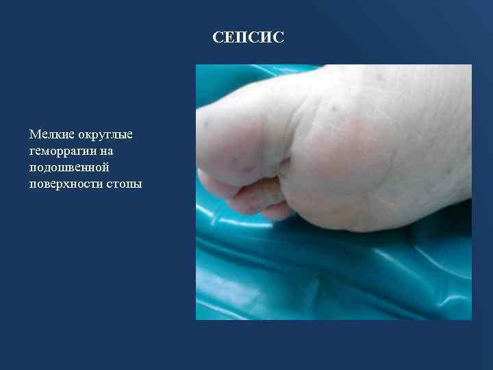 СЕПСИС Мелкие округлые геморрагии на подошвенной поверхности стопы 