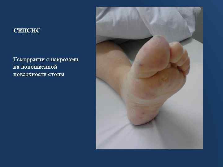 СЕПСИС Геморрагии с некрозами на подошвенной поверхности стопы 