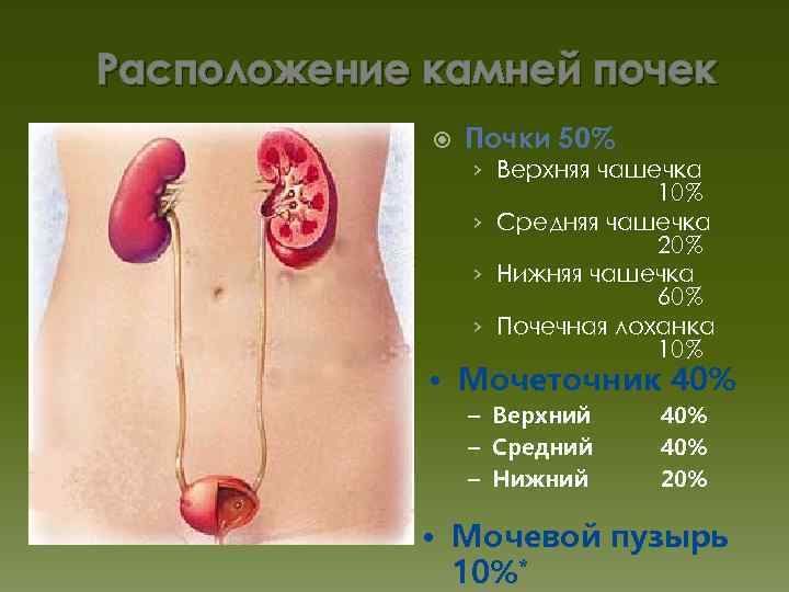 Расположение камней почек Почки 50% › Верхняя чашечка 10% › Средняя чашечка 20% ›