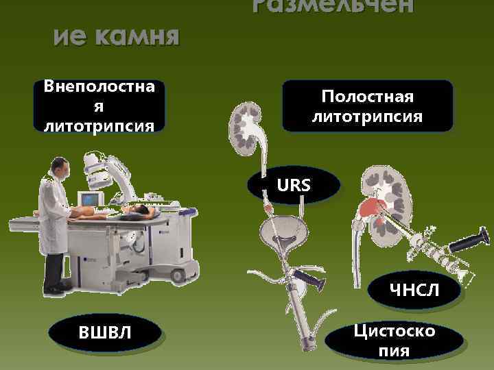 ие камня Размельчен Внеполостна я литотрипсия Полостная литотрипсия URS ЧНСЛ ВШВЛ Цистоско пия 