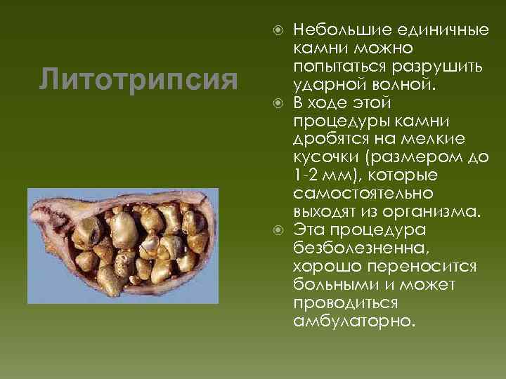 Небольшие единичные камни можно попытаться разрушить ударной волной. В ходе этой процедуры камни дробятся