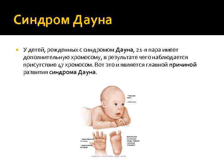 Синдром Дауна У детей, рожденных с синдромом Дауна, 21 -я пара имеет дополнительную хромосому,