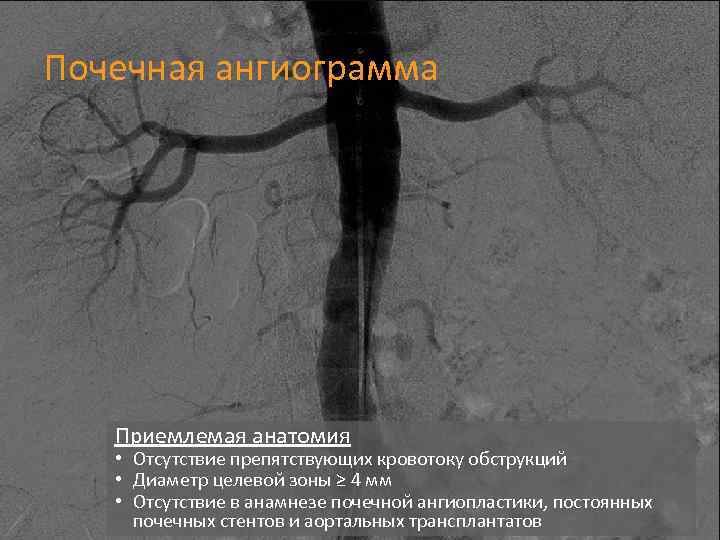 Почечная ангиограмма Приемлемая анатомия 12 • Отсутствие препятствующих кровотоку обструкций • Диаметр целевой зоны