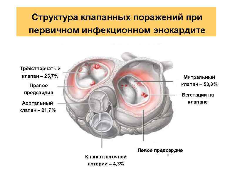 Самая частая причина смерти при инфекционном эндокардите