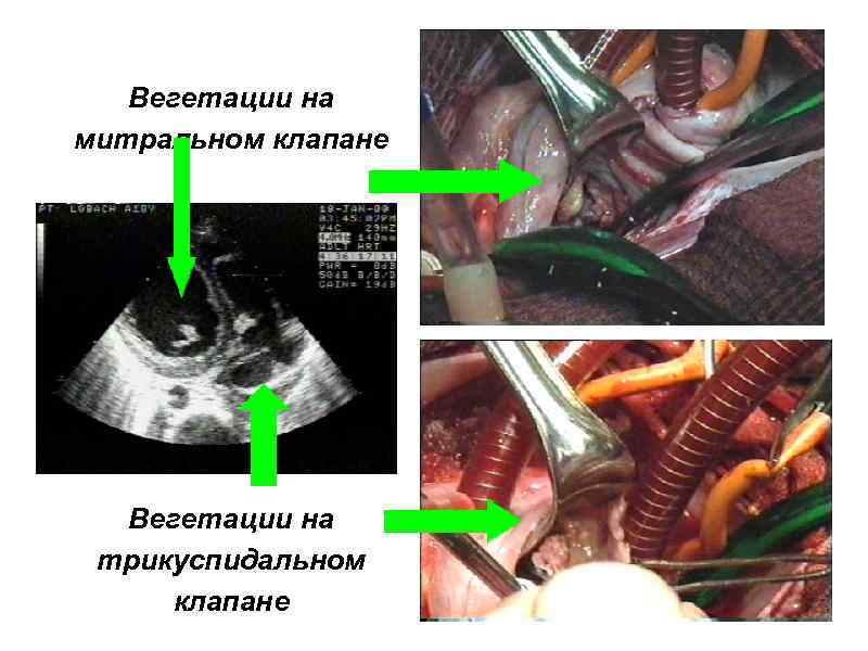 Паннус на митральном клапане