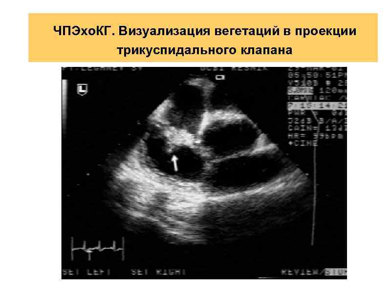 ЧПЭхо. КГ. Визуализация вегетаций в проекции трикуспидального клапана 