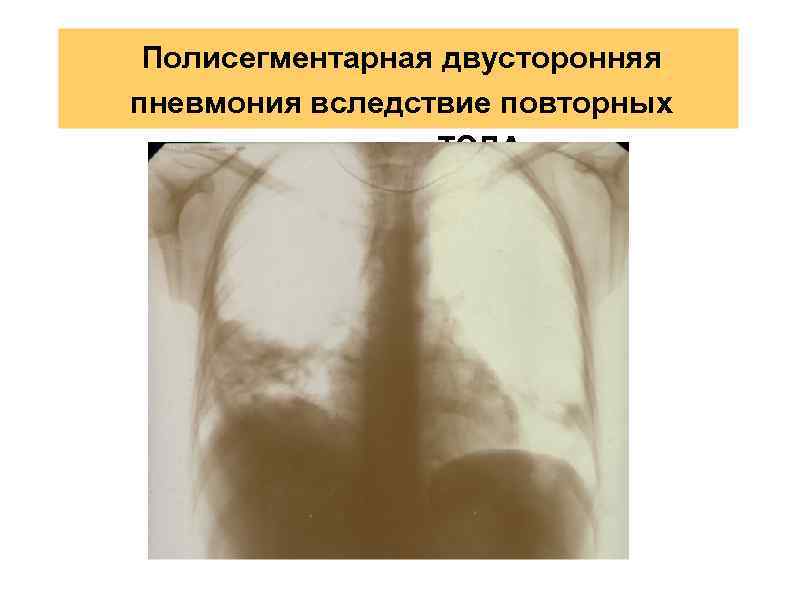 Полисегментарная двусторонняя пневмония вследствие повторных эпизодов ТЭЛА 