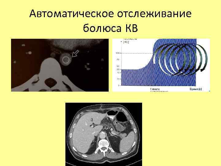 Автоматическое отслеживание болюса КВ 