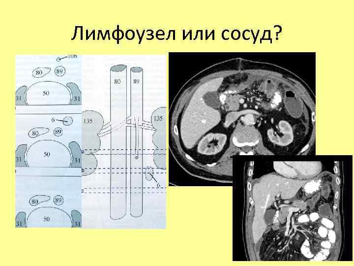 Лимфоузел или сосуд? 