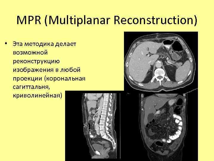 MPR (Multiplanar Reconstruction) • Эта методика делает возможной реконструкцию изображения в любой проекции (корональная