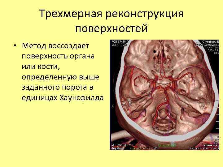 Трехмерная реконструкция поверхностей • Метод воссоздает поверхность органа или кости, определенную выше заданного порога