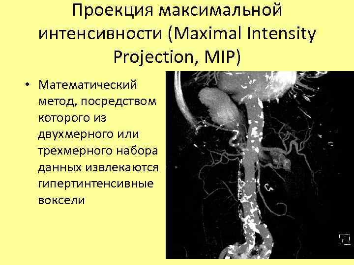 Проекция максимальной интенсивности (Maximal Intensity Projection, MIP) • Математический метод, посредством которого из двухмерного