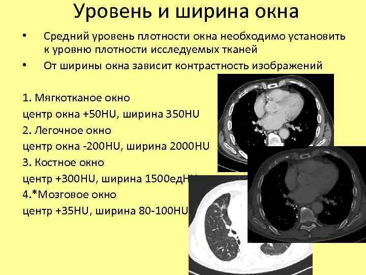 Уровень и ширина окна • • Средний уровень плотности окна необходимо установить к уровню