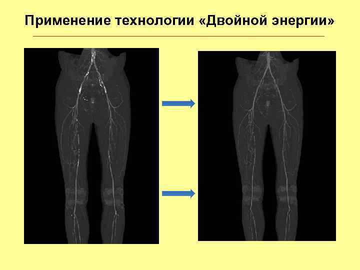 Применение технологии «Двойной энергии» 