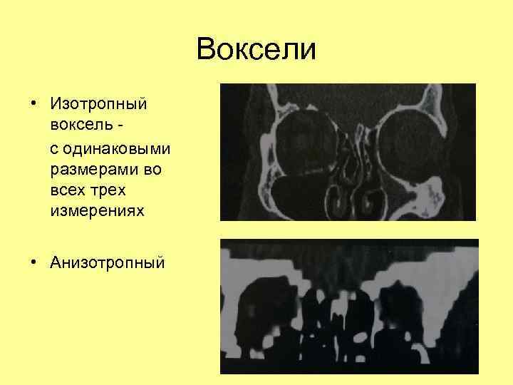 Воксели • Изотропный воксель с одинаковыми размерами во всех трех измерениях • Анизотропный 