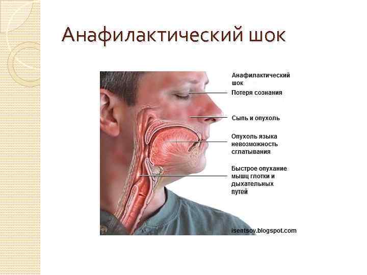 Анафилактический шок 