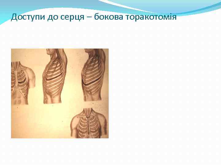 Доступи до серця – бокова торакотомія 