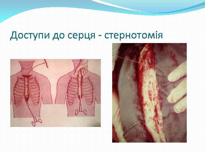 Доступи до серця - стернотомія 