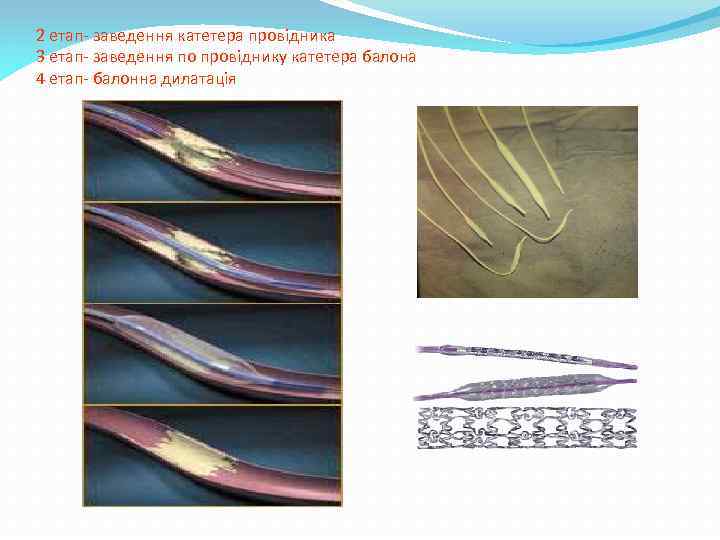 2 етап- заведення катетера провідника 3 етап- заведення по провіднику катетера балона 4 етап-