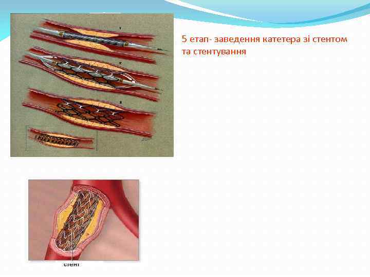 5 етап- заведення катетера зі стентом та стентування 