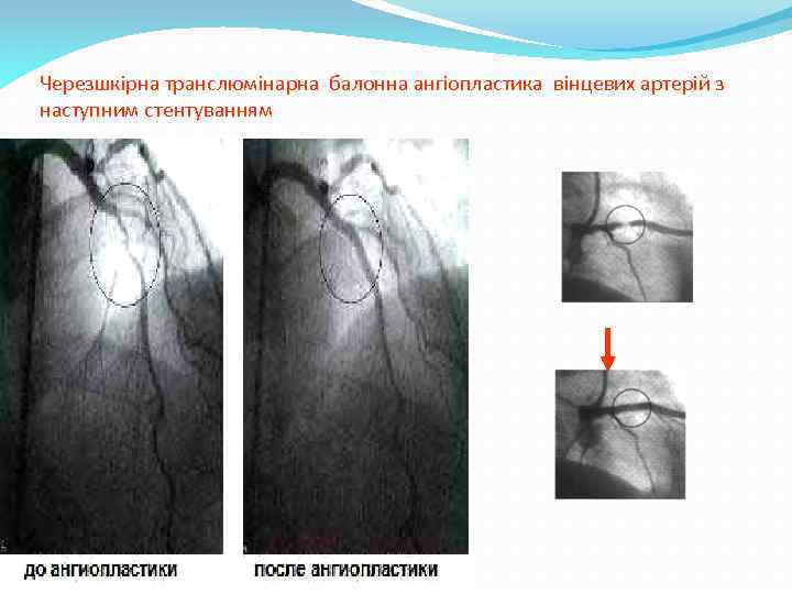 Черезшкірна транслюмінарна балонна ангіопластика вінцевих артерій з наступним стентуванням 