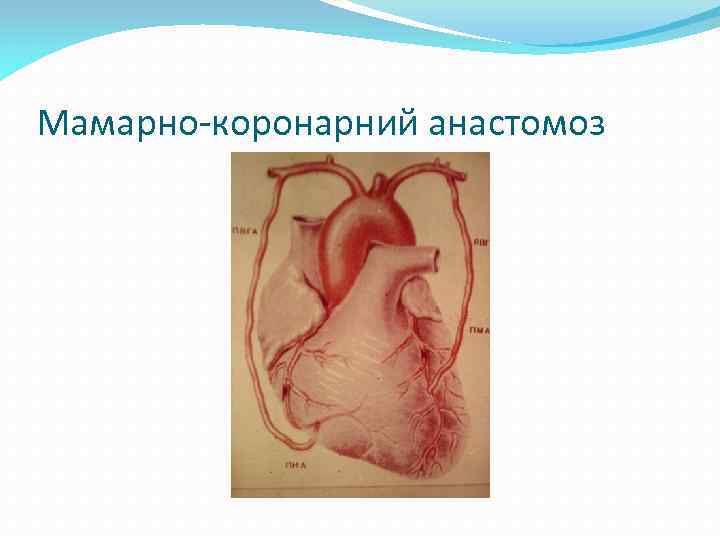 Мамарно-коронарний анастомоз 