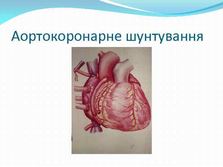 Аортокоронарне шунтування 