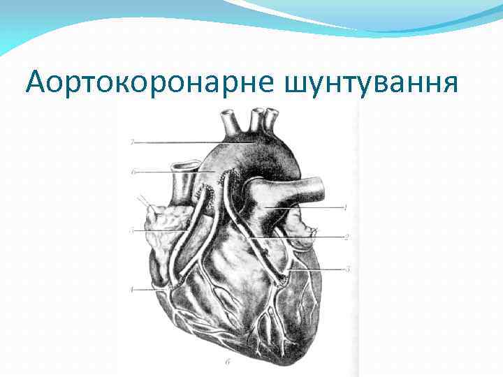 Аортокоронарне шунтування 