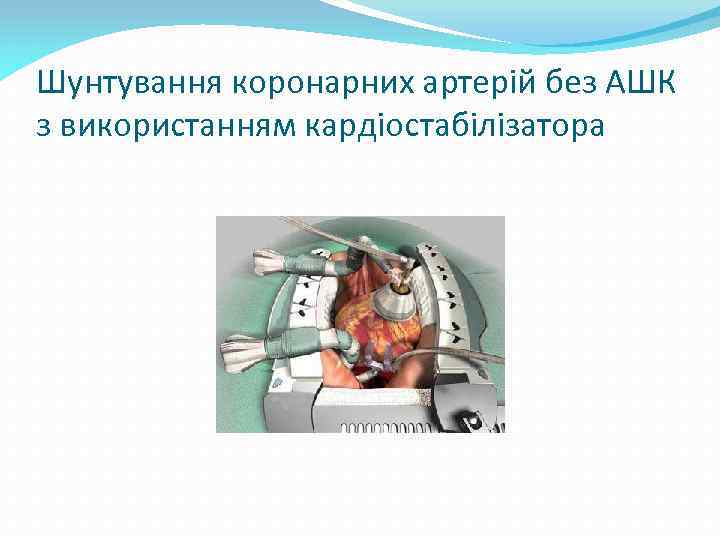 Шунтування коронарних артерій без АШК з використанням кардіостабілізатора 
