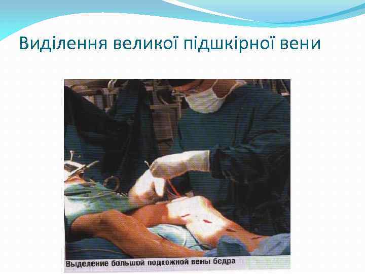 Виділення великої підшкірної вени 