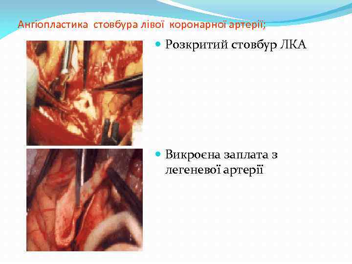 Ангіопластика стовбура лівої коронарної артерії; Розкритий стовбур ЛКА Викроєна заплата з легеневої артерії 