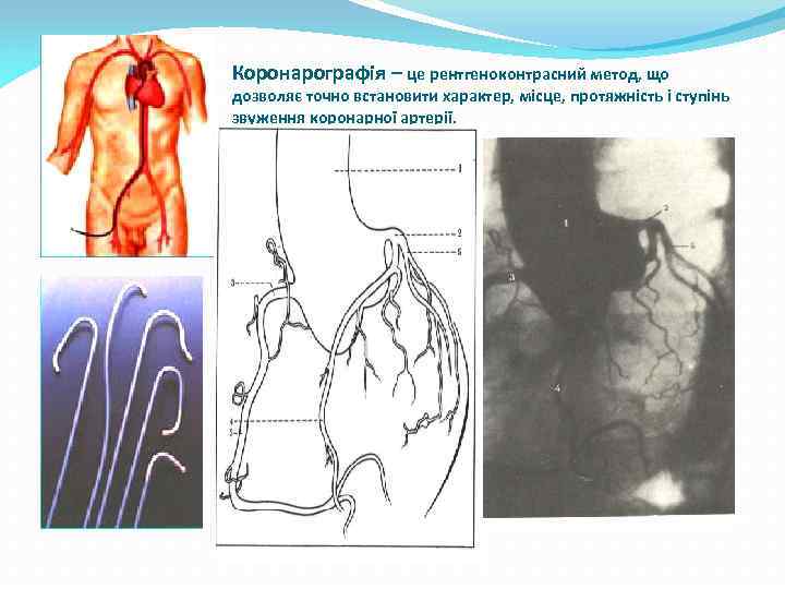 Коронарографія – це рентгеноконтрасний метод, що дозволяє точно встановити характер, місце, протяжність і ступінь