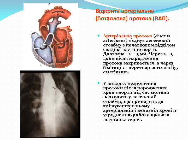 Відкрита артеріальна (боталлова) протока (ВАП). Артеріальна протока (ductus arteriosus) з'єднує легеневий стовбур з початковим