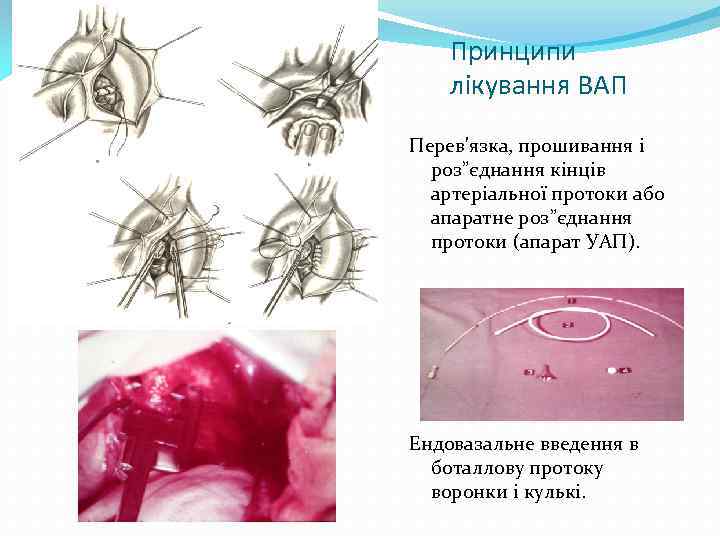 Принципи лікування ВАП Перев'язка, прошивання і роз”єднання кінців артеріальної протоки або апаратне роз”єднання протоки