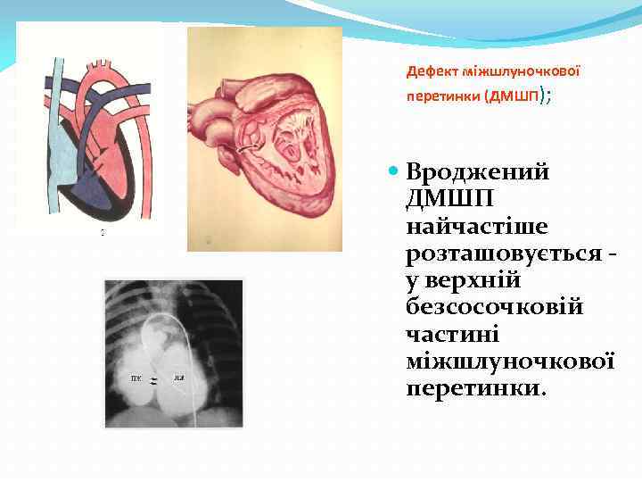 Дефект міжшлуночкової перетинки (ДМШП); Вроджений ДМШП найчастіше розташовується - у верхній безсосочковій частині міжшлуночкової