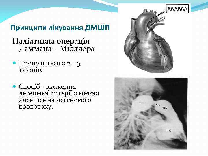 Принципи лікування ДМШП Паліативна операція Даммана – Мюллера Проводиться з 2 – 3 тижнів.