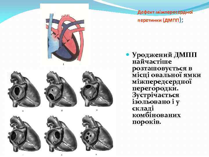 Дефект міжпересердної перетинки (ДМПП); Уроджений ДМПП найчастіше розташовується в місці овальної ямки міжпередсердної перегородки.