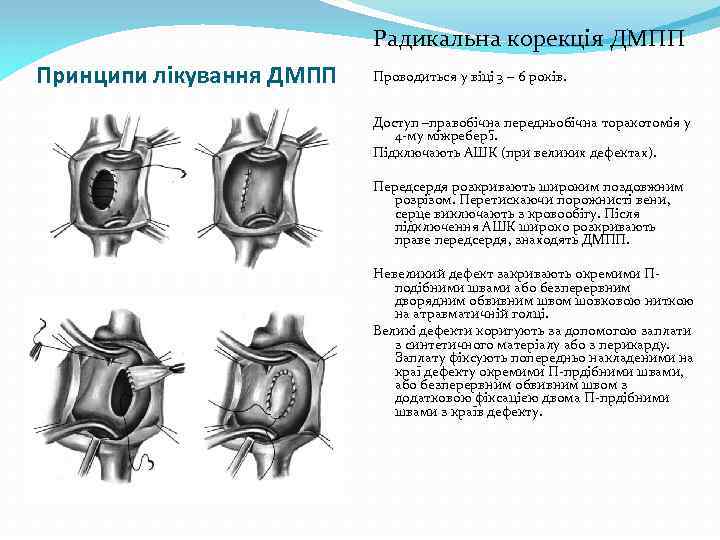 Радикальна корекція ДМПП Принципи лікування ДМПП Проводиться у віці 3 – 6 років. Доступ