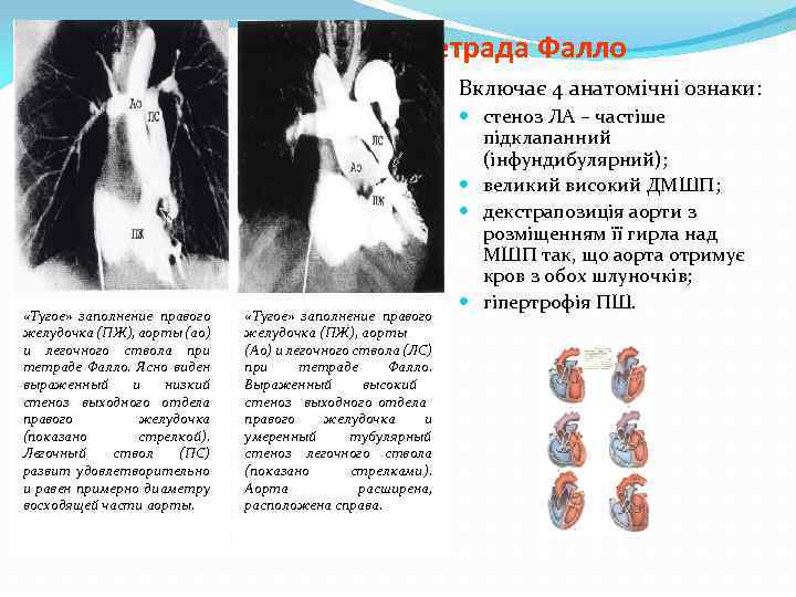Тетрада Фалло Включає 4 анатомічні ознаки: «Тугое» заполнение правого желудочка (ПЖ), аорты (ао) и