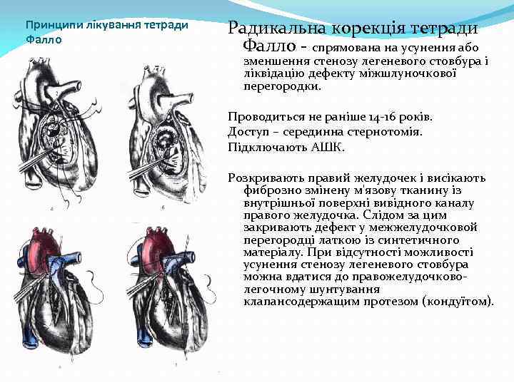 Принципи лікування тетради Фалло Радикальна корекція тетради Фалло спрямована на усунення або зменшення стенозу