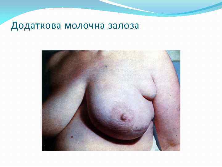 Додаткова молочна залоза 