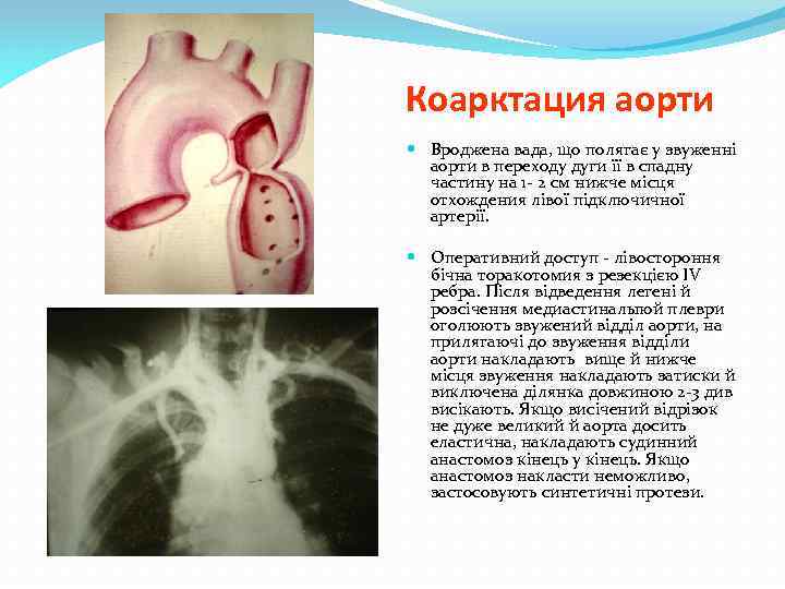 Коарктация аорти Вроджена вада, що полягає у звуженні аорти в переходу дуги її в