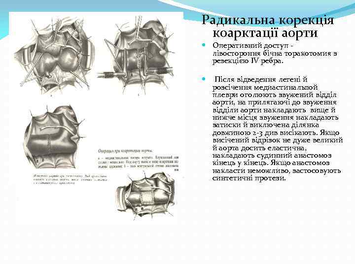 Радикальна корекція коарктації аорти Оперативний доступ лівостороння бічна торакотомия з резекцією IV ребра. Після
