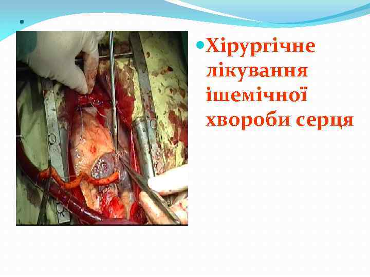 . Хірургічне лікування ішемічної хвороби серця 