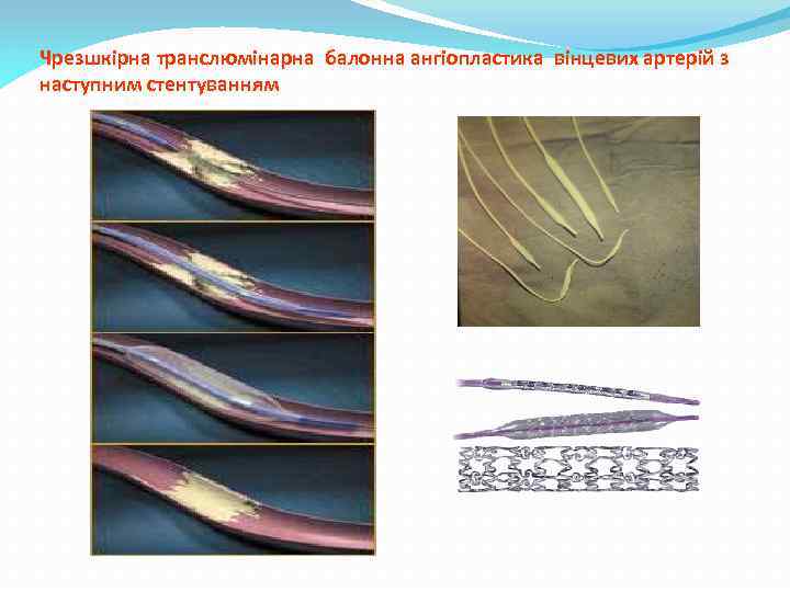 Чрезшкірна транслюмінарна балонна ангіопластика вінцевих артерій з наступним стентуванням 