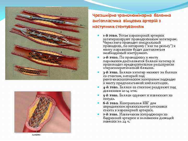 Чрезшкірна транслюмінарна балонна ангіопластика вінцевих артерій з наступним стентуванням 1 -й этап. Устье коронарной