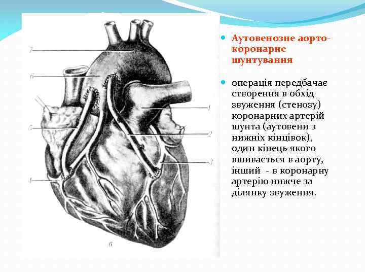 - Аутовенозне аортокоронарне шунтування операція передбачає створення в обхід звуження (стенозу) коронарних артерій шунта