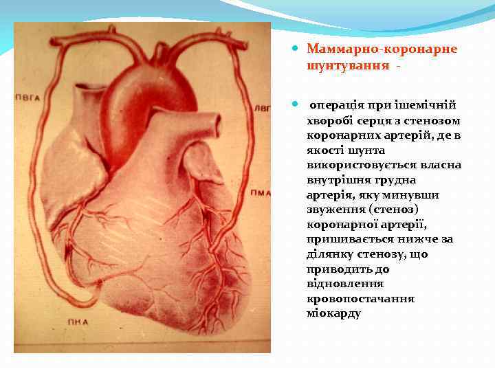  Маммарно-коронарне шунтування операція при ішемічній хворобі серця з стенозом коронарних артерій, де в