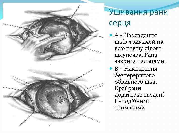 Ушивання рани серця А Накладання швів тримачей на всю товщу лівого шлуночка. Рана закрита